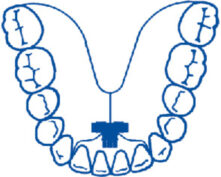 ECARTEUR TRI-DIRECTIONNEL MANDIBULAIRE (x1)