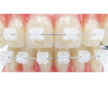 BRACKET AQUA  ROTH  ,022 T-22 2 PRMO LL BH 35 (x1)