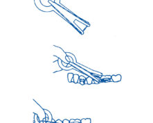 APPLICATEUR P/ELASTIQUES INTRAORAUX (x100)